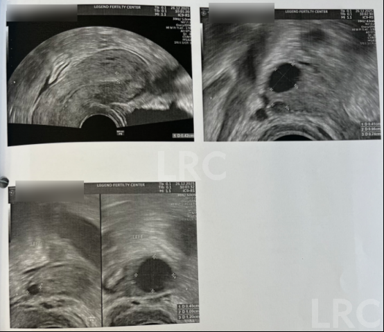 AMH0.18+高龄预警！LRC个性化温和刺激方案，开出取卵3、受精2、成囊2的好成绩~
