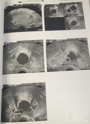 生育权不设限！35岁严重卵巢早衰，LRC针对性促排实现4取卵、全成熟，冻卵零浪费！