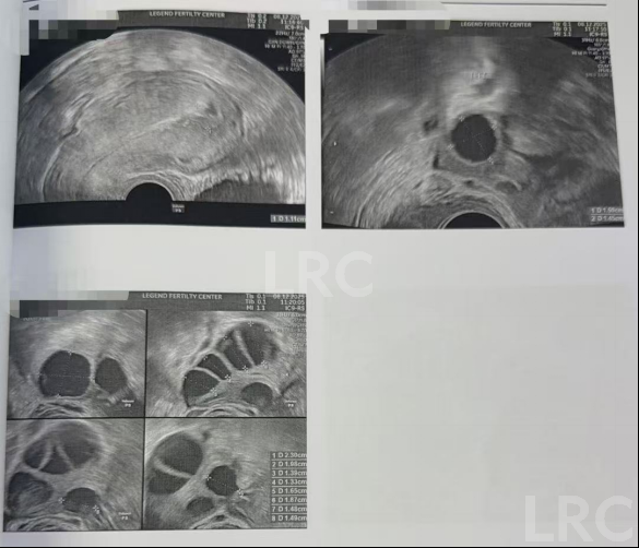39岁卵巢差+两梯队卵泡？LRC分阶连续促排全力挽救小卵泡，6枚囊胚逆袭好孕！