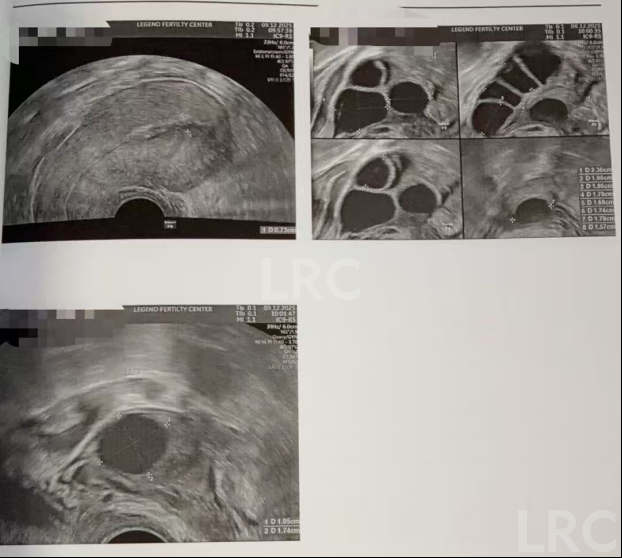 39岁卵巢差+两梯队卵泡？LRC分阶连续促排全力挽救小卵泡，6枚囊胚逆袭好孕！