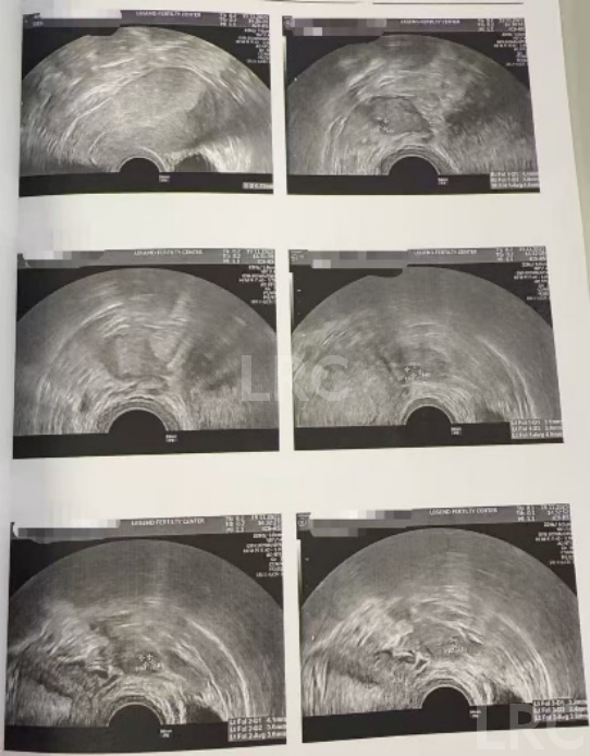 39岁卵巢差+两梯队卵泡？LRC分阶连续促排全力挽救小卵泡，6枚囊胚逆袭好孕！