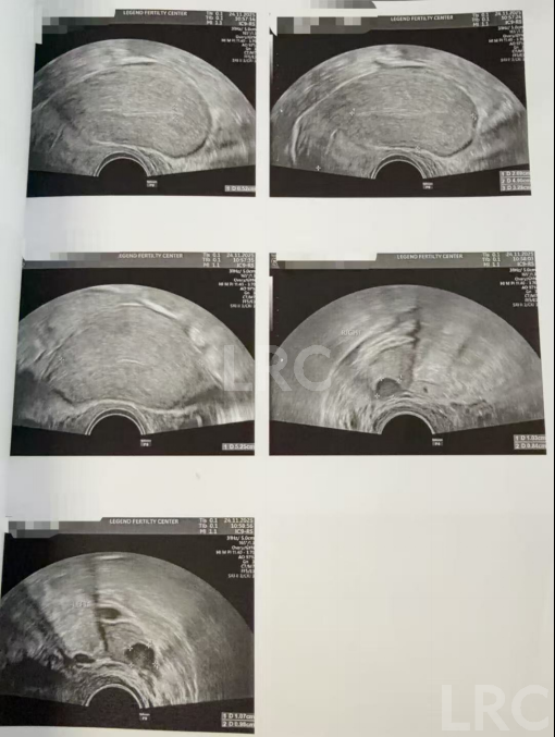 39岁卵巢差+两梯队卵泡？LRC分阶连续促排全力挽救小卵泡，6枚囊胚逆袭好孕！