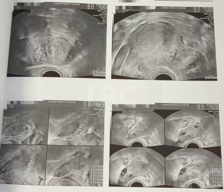 43+47双高龄暴击!LRC个性化促排实现解锁高成囊率,取卵10→受精8→成囊6!