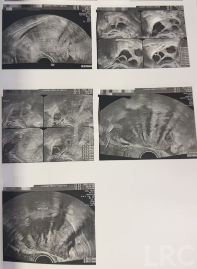 43+47双高龄暴击!LRC个性化促排实现解锁高成囊率,取卵10→受精8→成囊6!