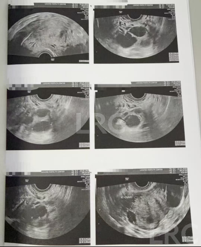 43+47双高龄暴击!LRC个性化促排实现解锁高成囊率,取卵10→受精8→成囊6!