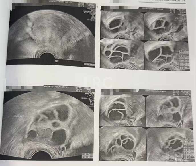 双侧巧囊+男方精子差?LRC个性化诊疗,取20卵成囊11颗,好孕破局~