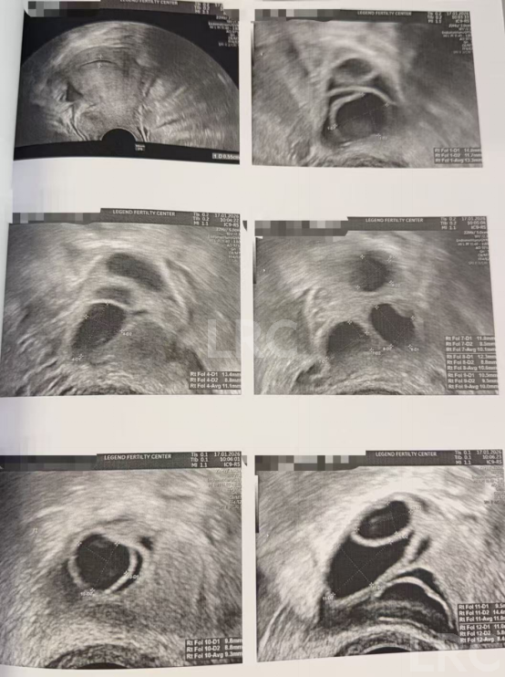 双侧巧囊+男方精子差?LRC个性化诊疗,取20卵成囊11颗,好孕破局~