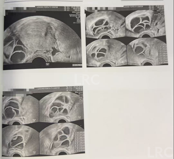双侧巧囊+男方精子差?LRC个性化诊疗,取20卵成囊11颗,好孕破局~