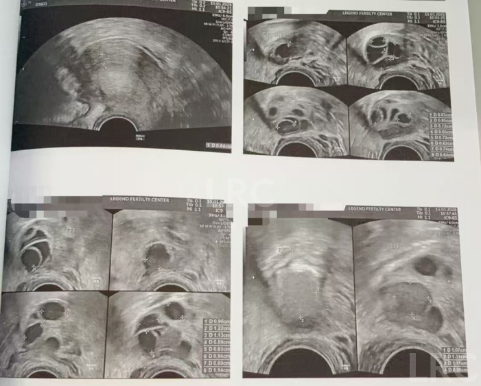 双侧巧囊+男方精子差?LRC个性化诊疗,取20卵成囊11颗,好孕破局~