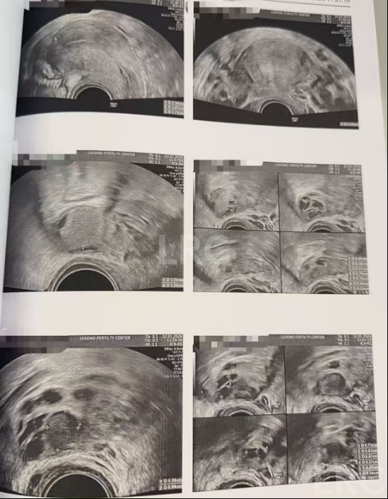 双侧巧囊+男方精子差?LRC个性化诊疗,取20卵成囊11颗,好孕破局~