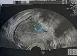 LRC助力：多囊卵巢综合征不是障碍，从不孕到三代试管婴儿的成功之路