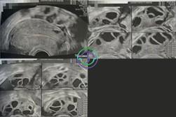 LRC助力：多囊卵巢综合征不是障碍，从不孕到三代试管婴儿的成功之路