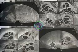 LRC助力：多囊卵巢综合征不是障碍，从不孕到三代试管婴儿的成功之路