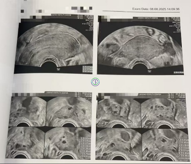 精子碎片高+卵子也长不均？LRC个性化促排+精子筛选双buff叠满，实现受精养囊百分百！