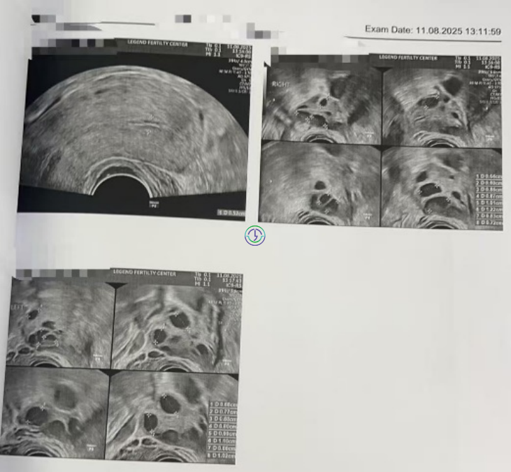 精子碎片高+卵子也长不均？LRC个性化促排+精子筛选双buff叠满，实现受精养囊百分百！