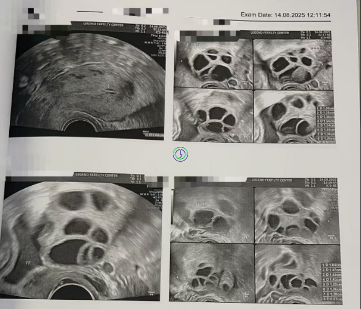 精子碎片高+卵子也长不均？LRC个性化促排+精子筛选双buff叠满，实现受精养囊百分百！