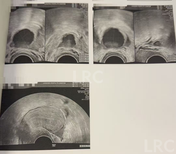 37岁卵巢衰退遇上精子质量差，LRC温和刺激方案，仅取卵3颗，就养成2枚囊胚！
