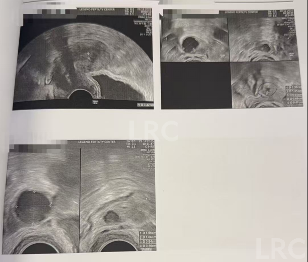 37岁卵巢衰退遇上精子质量差，LRC温和刺激方案，仅取卵3颗，就养成2枚囊胚！