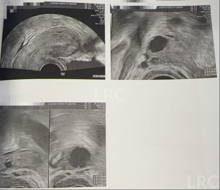 37岁卵巢衰退遇上精子质量差，LRC温和刺激方案，仅取卵3颗，就养成2枚囊胚！