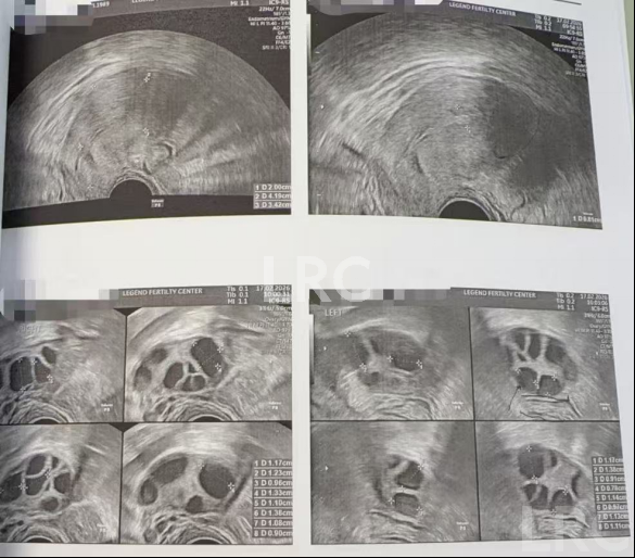 37岁卵泡不均难促排，LRC精准促排实现受精养囊双百，拿下10颗囊胚！