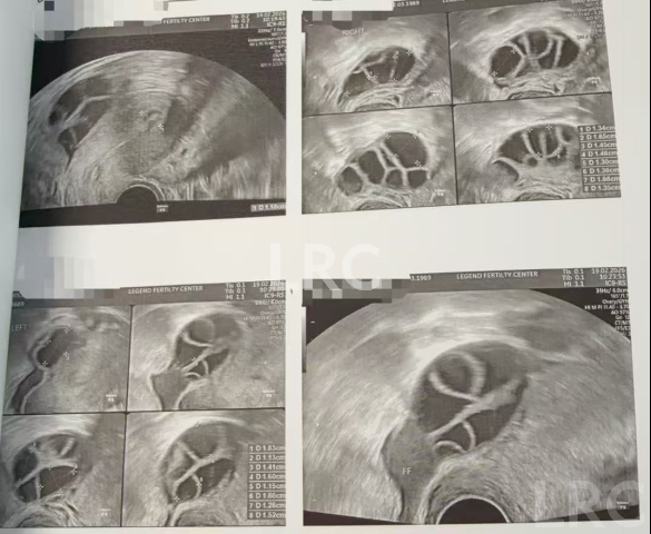 37岁卵泡不均难促排，LRC精准促排实现受精养囊双百，拿下10颗囊胚！