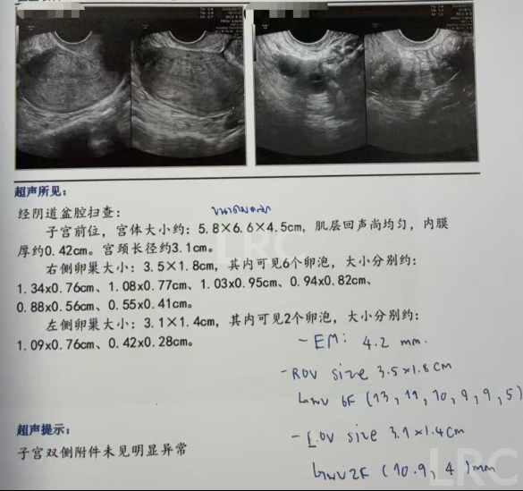 40岁卵泡不均+47岁精子双低！LRC用个性化促排盘活稀缺卵泡，4颗胚胎全成囊！