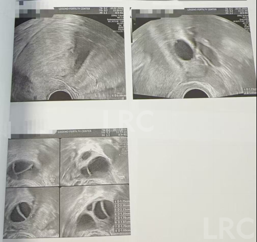 40岁卵泡不均+47岁精子双低！LRC用个性化促排盘活稀缺卵泡，4颗胚胎全成囊！