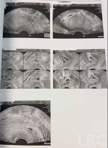 38岁卵巢反应不良、卵泡停滞,LRC精准调理促排+硬核养囊,5枚受精卵全成囊,稳拿健康胚!