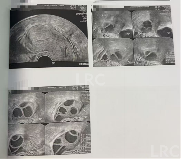 38岁卵巢反应不良、卵泡停滞，LRC精准调理促排+硬核养囊，5枚受精卵全成囊，稳拿健康胚！