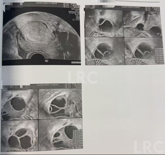 38岁卵巢反应不良、卵泡停滞，LRC精准调理促排+硬核养囊，5枚受精卵全成囊，稳拿健康胚！