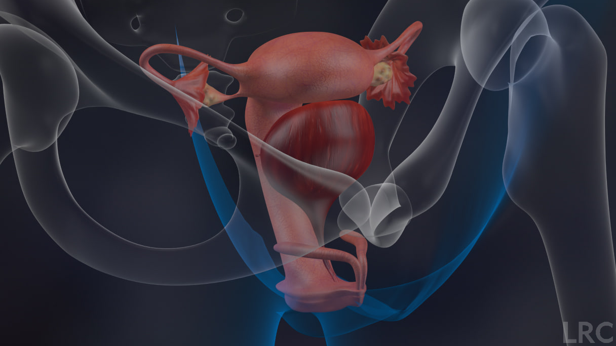 严重少弱畸精症，LRC精子优选技术让“劣质精子”逆袭