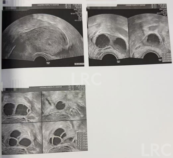 44岁高龄+卵泡不同步，LRC个性化促排方案帮她拿下2枚囊胚！
