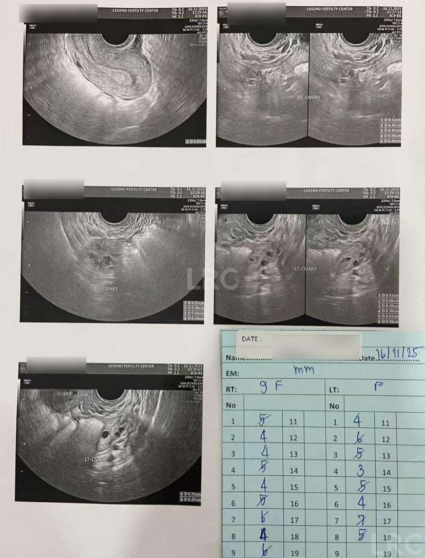 男方69岁重度弱精翻盘!LRC DGC高密梯度离心法+个性化促排方案,6周见胎心