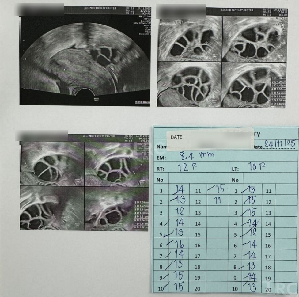 男方69岁重度弱精翻盘!LRC DGC高密梯度离心法+个性化促排方案,6周见胎心