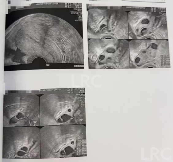 28岁卵巢早衰,卵泡大小乱成一团,LRC个性化促排全程监测,最终5颗受精卵全部成囊!