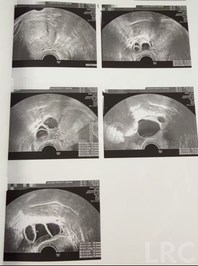 28岁卵巢早衰,卵泡大小乱成一团,LRC个性化促排全程监测,最终5颗受精卵全部成囊!