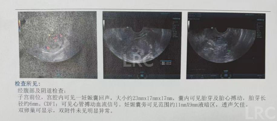 男方69岁重度弱精翻盘!LRC DGC高密梯度离心法+个性化促排方案,6周见胎心