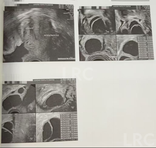 28岁卵巢早衰,卵泡大小乱成一团,LRC个性化促排全程监测,最终5颗受精卵全部成囊!