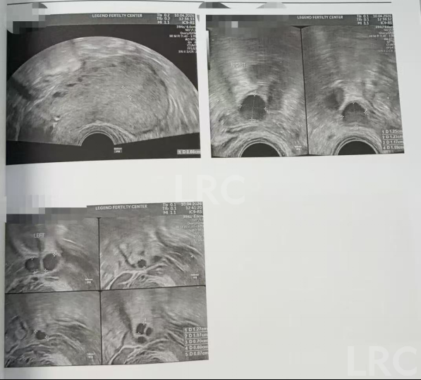 44岁高龄+卵泡不同步，LRC个性化促排方案帮她拿下2枚囊胚！