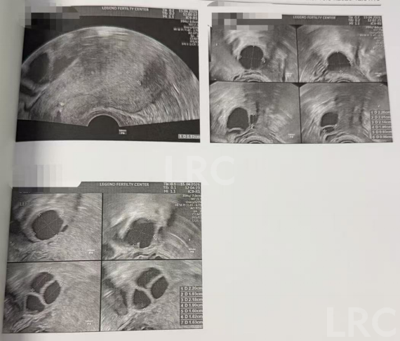 44岁高龄+卵泡不同步，LRC个性化促排方案帮她拿下2枚囊胚！